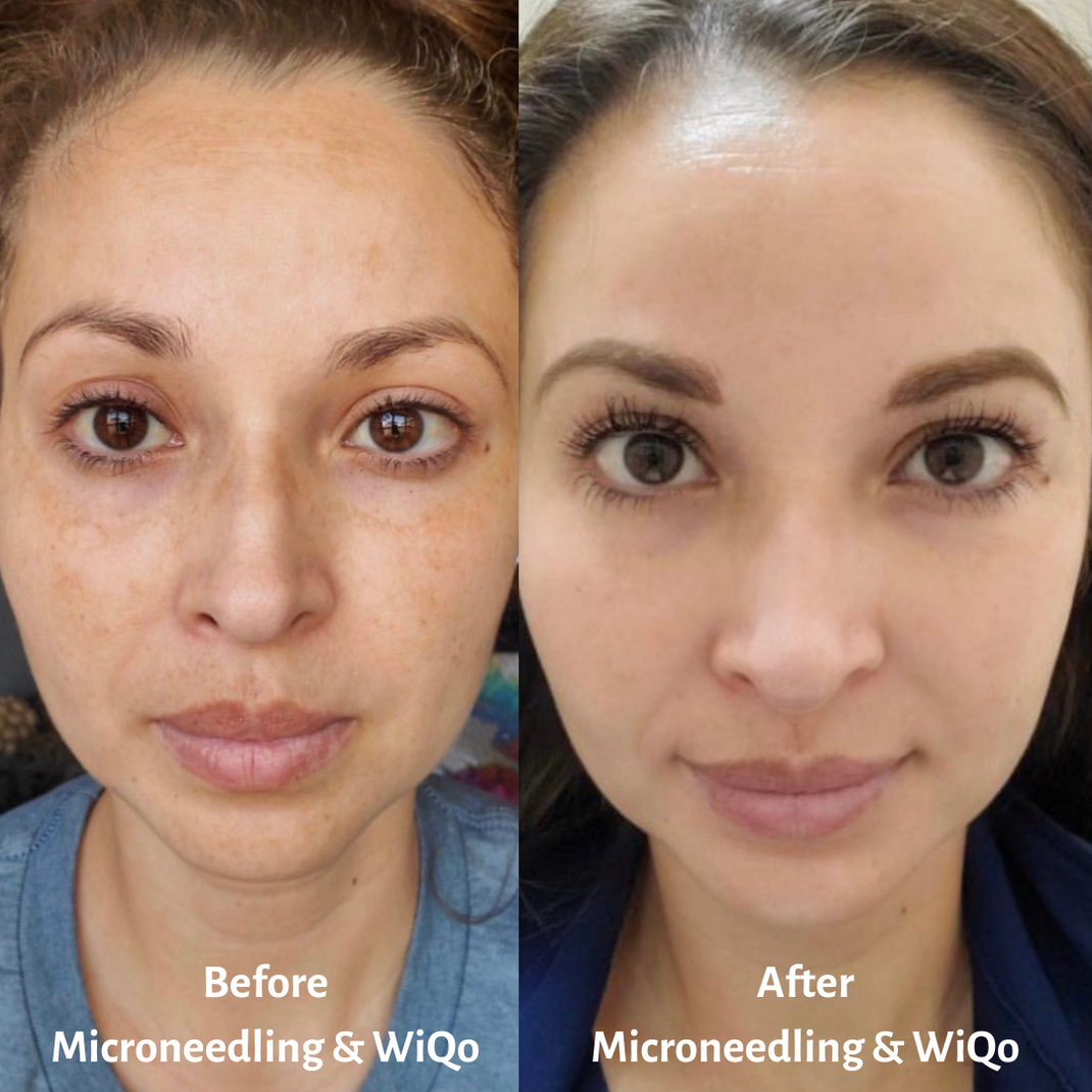 Experience WiQo PRX Peel for Great Skin in San Antonio | The Skin Elite ...